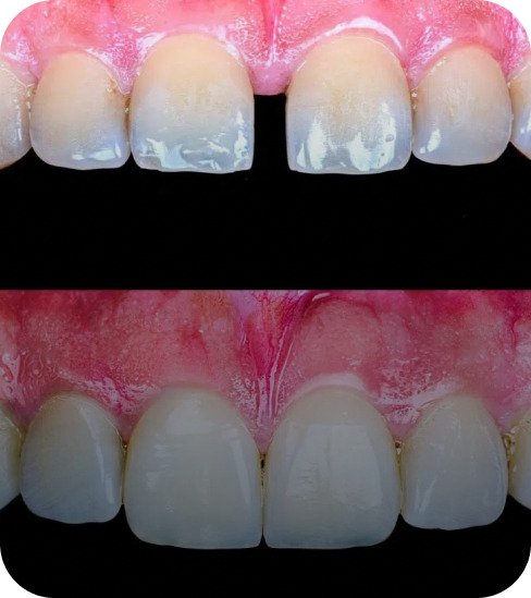 Master the art of designing veneers to close gaps seamlessly 
treatments