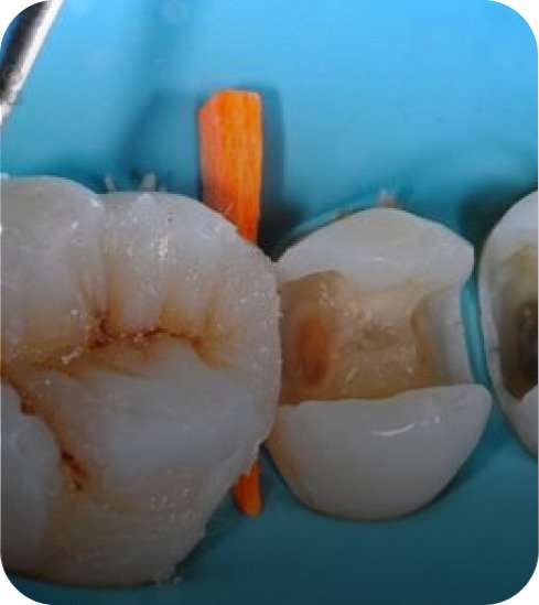 Explore techniques for durable and aesthetic posterior restorations