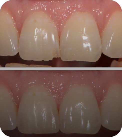 Perfect aesthetic restorations using layered composites