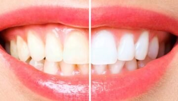 teeth whitening pic